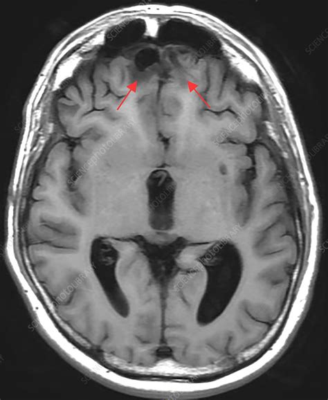 Chronic Post-Traumatic Brain Injury, MRI - Stock Image - C030/6066 ...