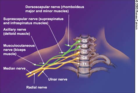 Brachial Neuritis Differential Diagnosis - Israel-has-Mcintosh