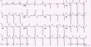 Pacemakers - ECGpedia