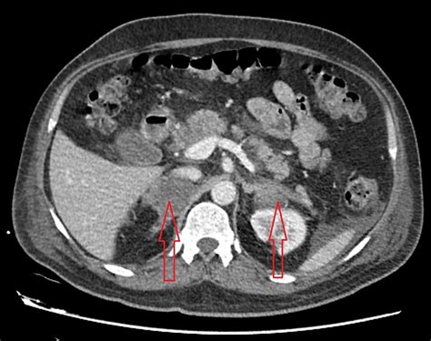 Enlarged adrenal gland symptoms - bdabooks