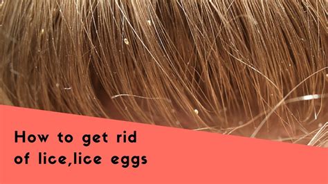 Tips to get rid of lice eggs|lice eggs removal home remedies|KRI GA ...