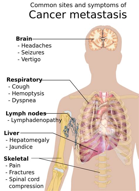 Signs and symptoms of cancer - Wikipedia