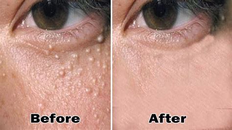 Milia Treatment - 3 Weeks To Remove Milia and White Bumps Under Eyes By ...