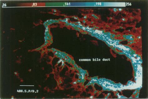 Fluorescence micrograph of common bile duct. High fluorescence in the ...