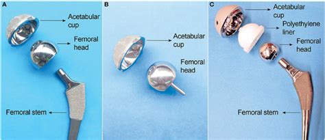 A typical prosthesis showing ball-and-socket joint regions where: (A ...