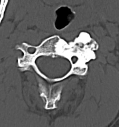 Osteoblastoma Spine