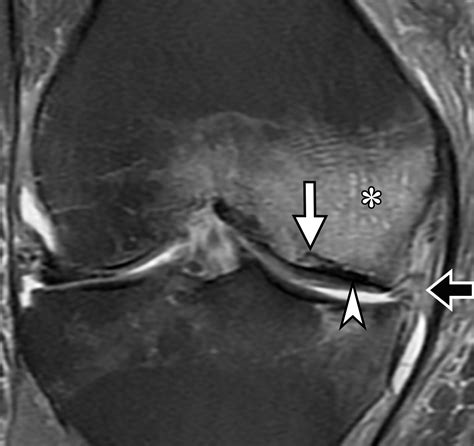 Osteochondral Lesions of the Knee: Differentiating the Most Common ...