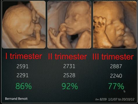 20 week ultrasound 4d - revAslo