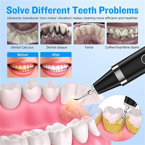 Ultrasonic Plaque Remover & Dental Cleaner Kit | 5 Modes for Calculus ...