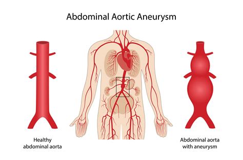 Abdominal Aortic Aneurysms — Vascular Cures