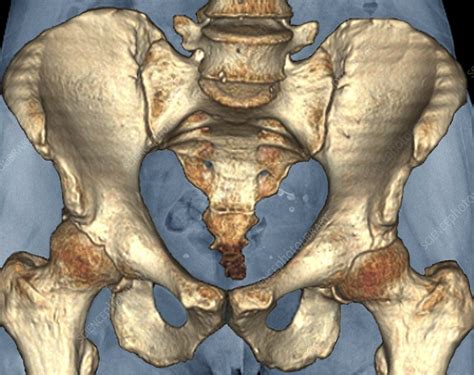 Healthy pelvis, 3D CT scan - Stock Image - C009/5448 - Science Photo ...