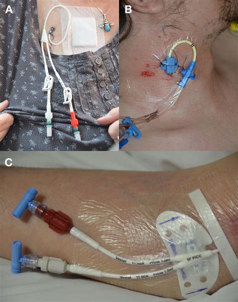 Central venous catheters | The BMJ