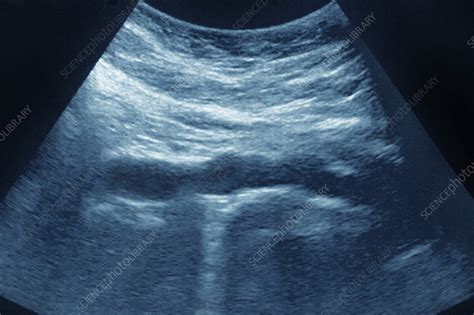 Aortic atheroma, ultrasound scan - Stock Image - C055/4995 - Science ...