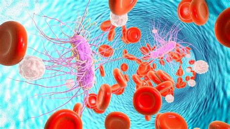 Septicemia: Causes, Symptoms, Treatment - Medicine.com