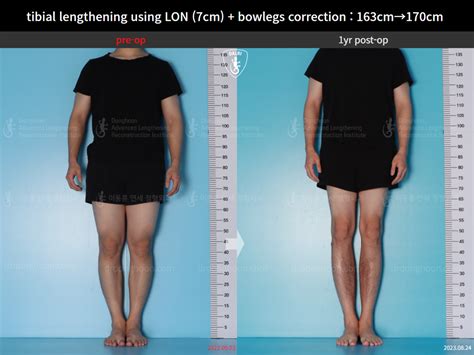 tibial lengthening using LON (7cm) + bowlegs correction : 163cm→170cm ...