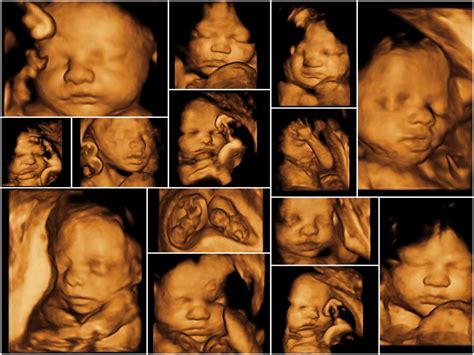 what do people see in a sonogram? : r/NoStupidQuestions