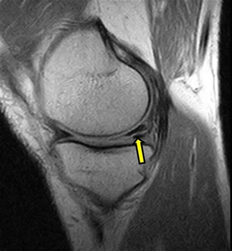 How To Read Knee Mri Knee Mri Mri Scan Meniscus Tear | Images and ...