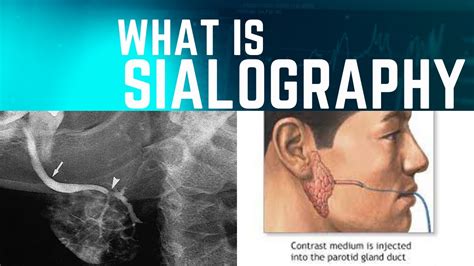 Sialography X-ray Procedure|Sialography Procedure |In Urdu|Hindi @ Easy ...