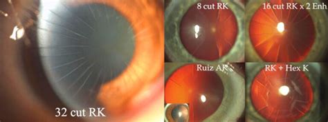 RK Surgery / Radial Keratotomy Correction | Gulani Vision Institute