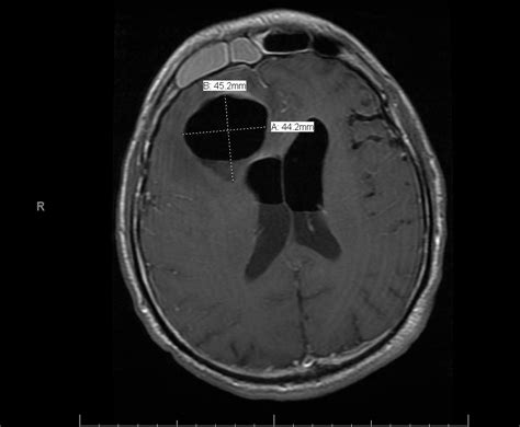 Acute Frontal Sinusitis Surgery