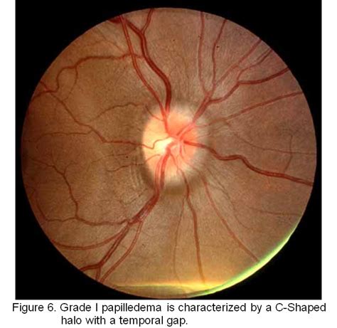 Papilledema Grades. EyeRounds.org - Ophthalmology - The University of Iowa