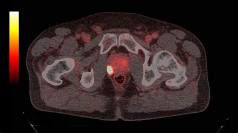 Prostate Cancer Staging (PSMA PET Scan) | Northern Beaches Urology