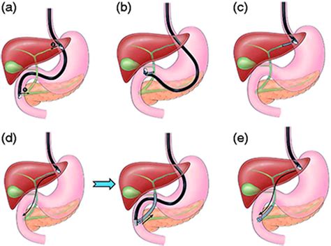 Outcomes of endoscopic ultrasound‐guided biliary drainage: A systematic ...