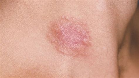 Leukemia Rash Pictures, Signs, and Symptoms | Everyday Health - vwin app