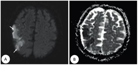 Brain diffusion magnetic resonance imaging showing areas of restricted ...