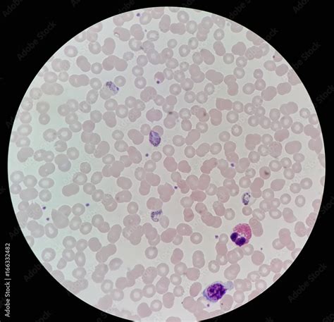 Under 100X light microscope, human parasite on thin film of blood smear ...