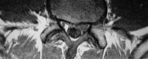 L5 S1 Disc hard Extrusion – Radiopaedia