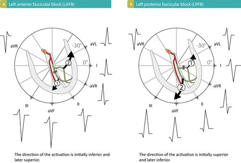 Fascicular block (hemiblock): left anterior fascicular block & left ...