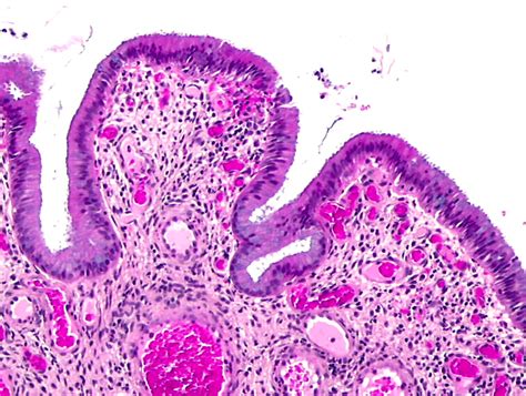 Endocervical Polyp Histology