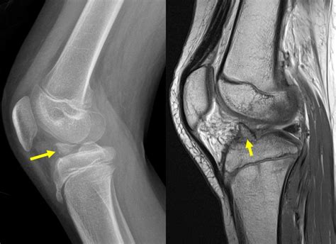 Avulsion fracture of ACL – Radiology Cases