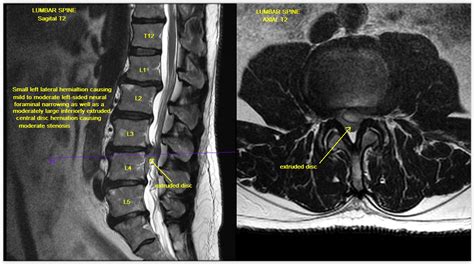 Lumbar Spine Mri Herniation