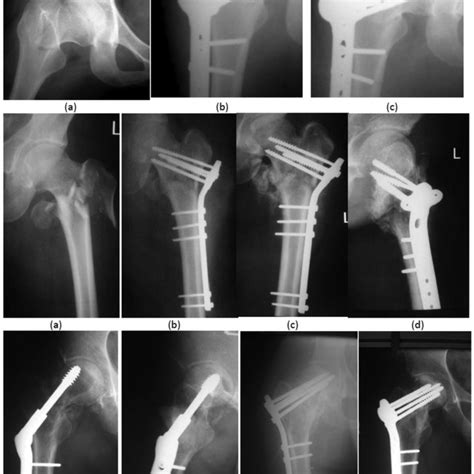 Treatment of femoral neck fracture with cloverleaf locking plate ...