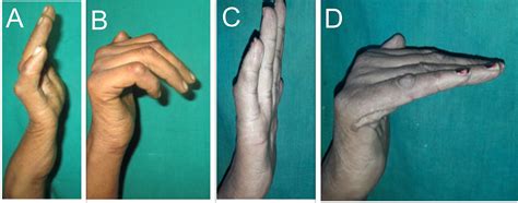 Dynamic correction of ulnar claw hand deformity with a simple insertion ...