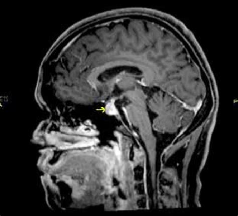 Pituitary Tumor Mri