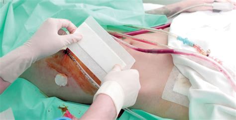 Treat an incision with wound-care precision | Healthcare Purchasing News