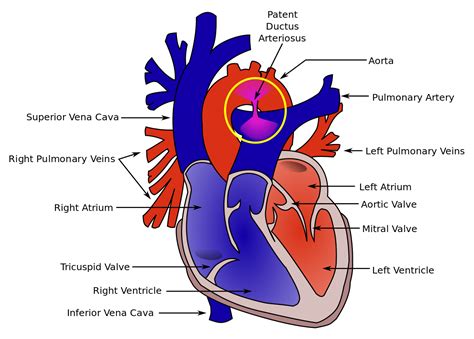 File:Patent ductus arteriosus.svg - Wikipedia