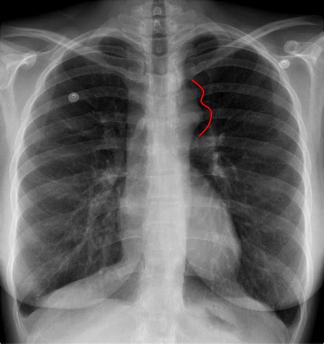 Medical Addicts: Chest X-ray: Coarctation of Aorta: Figure 3 sign