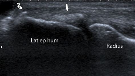 Common Extensor Tendon Ultrasound