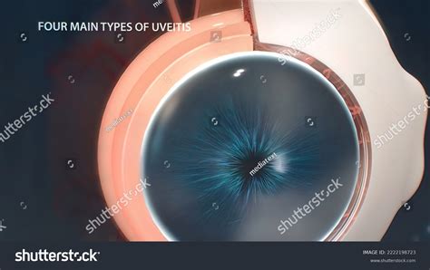 Uveitis Inflammation Part All Uvea Eye Stock Illustration 2222198723 ...