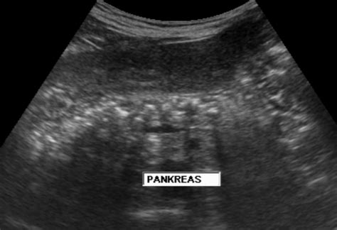 Chronic Pancreatitis Ultrasound