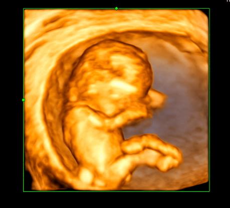 Sonogram Secrets by Trimester - Advanced Ultrasound Services