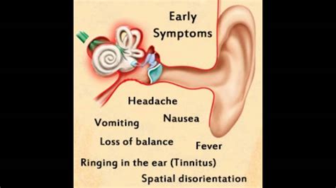 Vertigo caused by inner ear infection: Vertigo: Causes, Symptoms, and ...