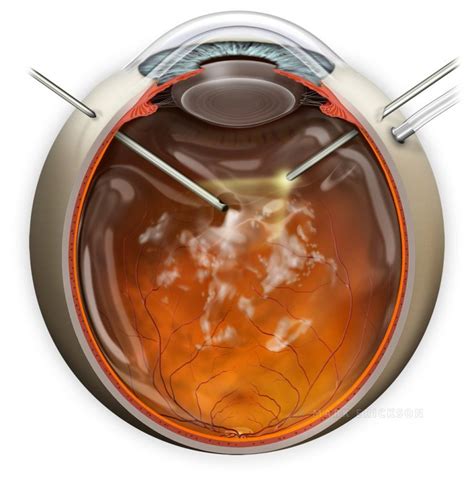 Pars plana vitrectomy PPV for vitreous debris, surgery illustration