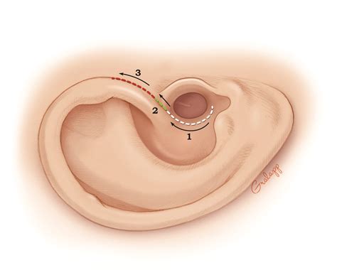 Endaural Meatoplasty – Oto Surgery Atlas