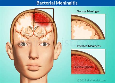 Bacterial Meningitis|Causes|Risk Factors|Symptoms|Diagnosis|Treatment ...