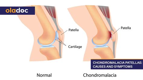 Chondromalacia Patellae: Causes and Symptoms | Bones and Joints ...